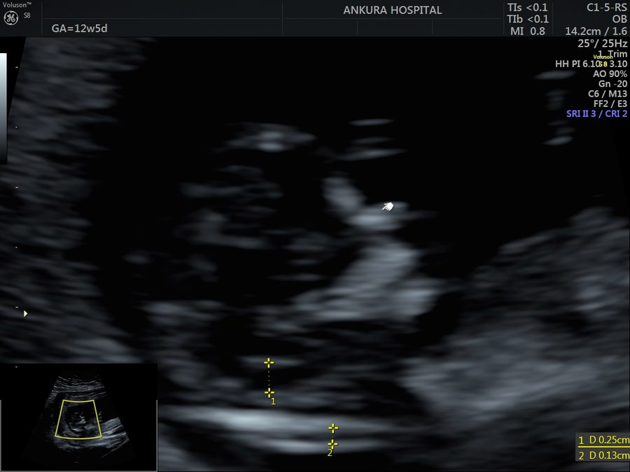 FMF-standard equipment for accurate first-trimester measurement