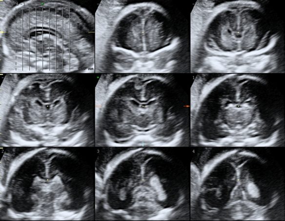Fetal Neurosonogram