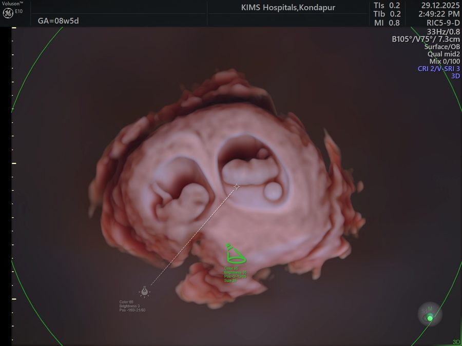 Twin Pregnancy Scans